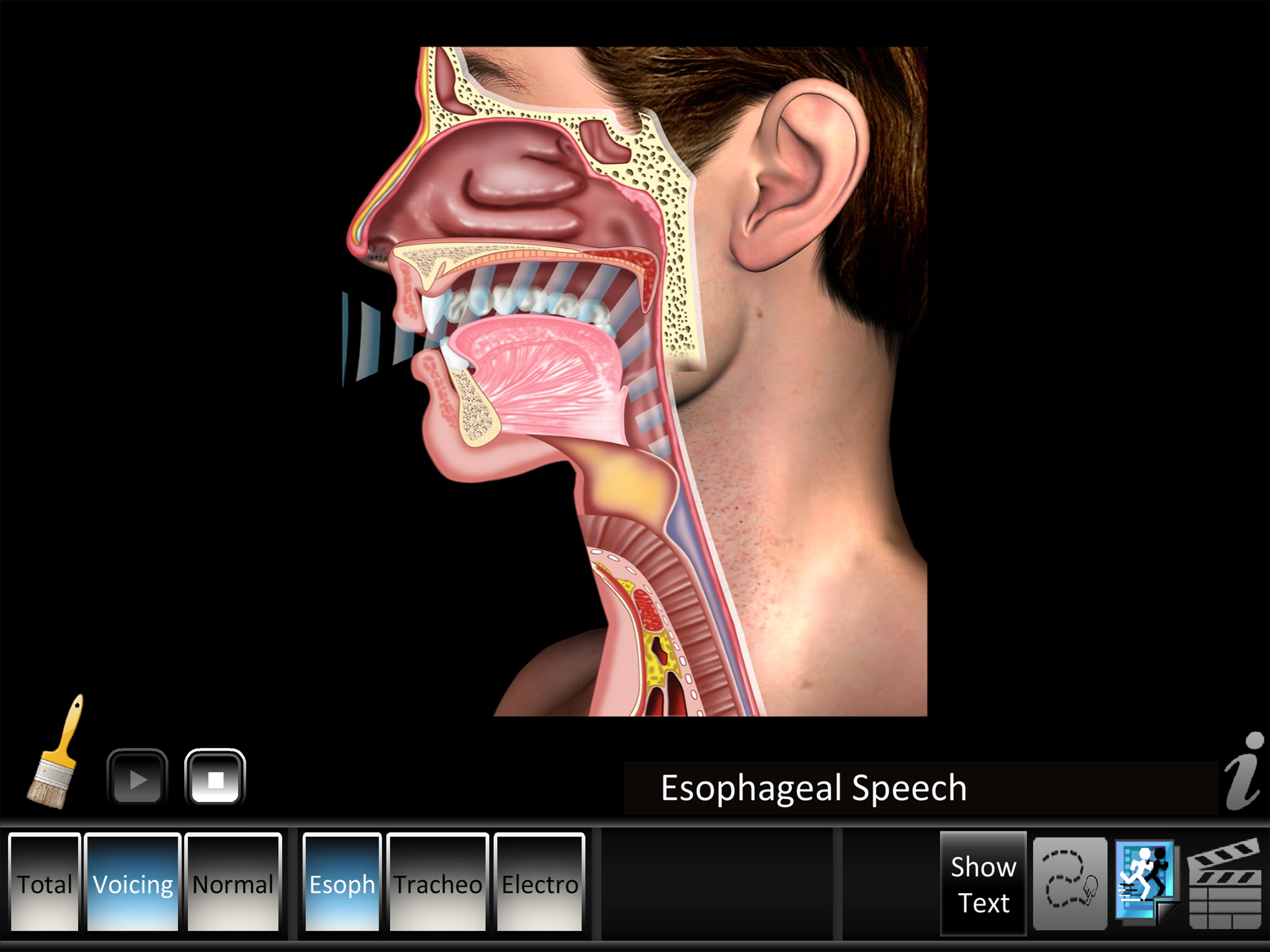 Laryngectomy