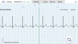 Q-ecg screenshot 2