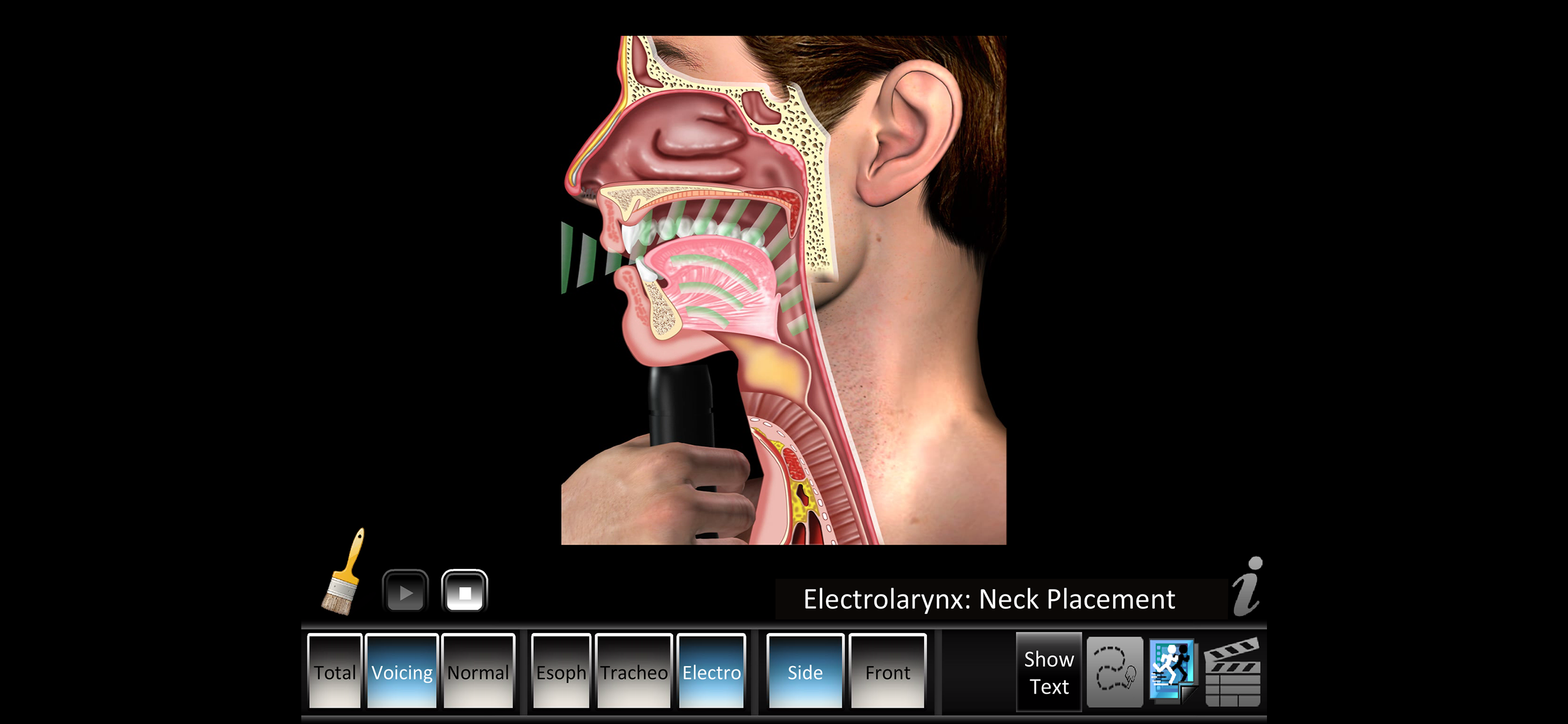 Laryngectomy