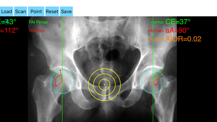 FemoroAcetabularImpingementApp