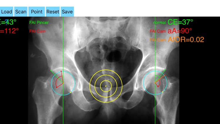 FemoroAcetabularImpingementApp screenshot-6