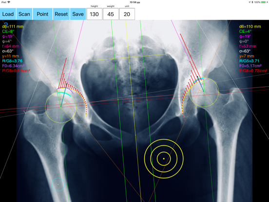 Screenshot #6 pour HipBiomechanicsApp