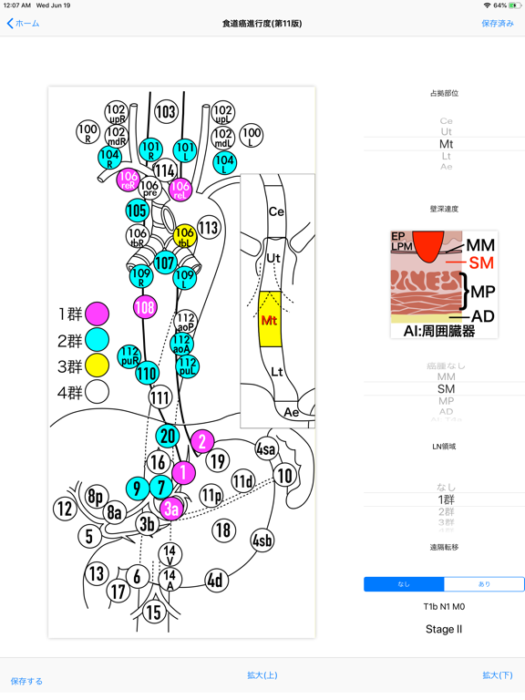 Screenshot #4 pour 肝硬変重症度Child分類・消化器癌進行度分類