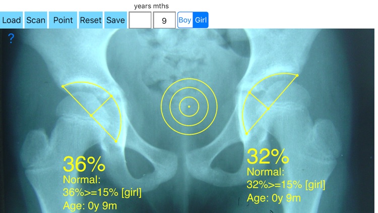 AcetabularDepthRatioApp screenshot-0