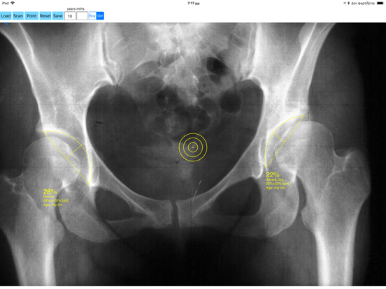 Screenshot #5 pour AcetabularDepthRatioApp