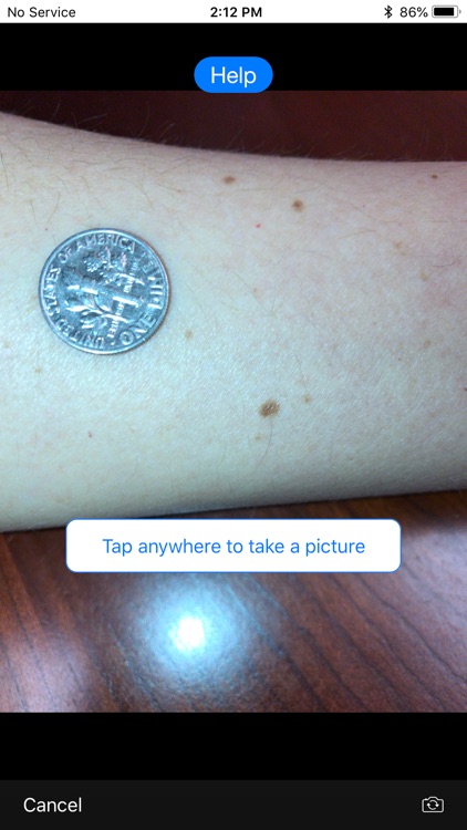 Mole Mapper Melanoma Study