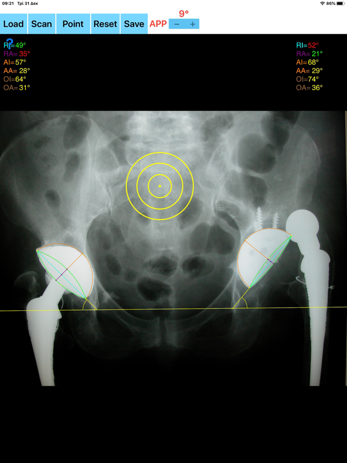 CupAnteversionInclinationApp