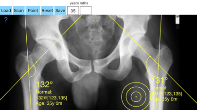 NeckShaftAngle App Screenshot