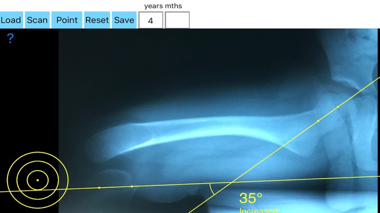 FemoralAnteversionApp