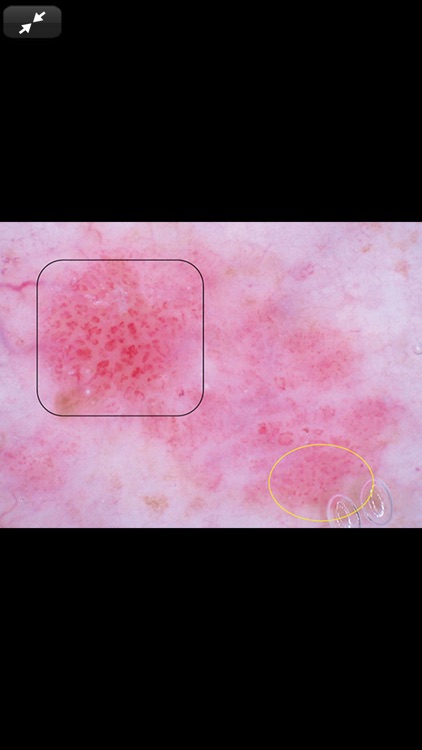 Dermoscopy Criteria Review screenshot-7