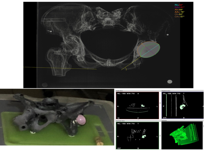 CupAnteversionInclinationApp