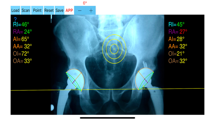 CupAnteversionInclinationApp