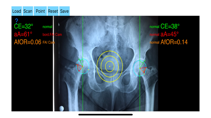FemoroAcetabularImpingementApp