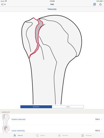 AO/OTA Fracture Classificationのおすすめ画像4