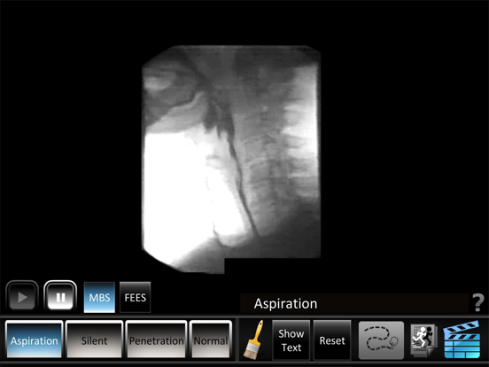 Aspiration Disorders iPad app afbeelding 4