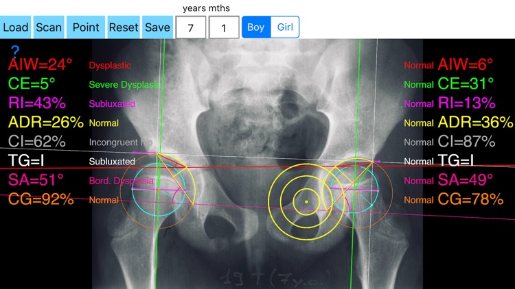 HipDysplasiaApp screenshot-0