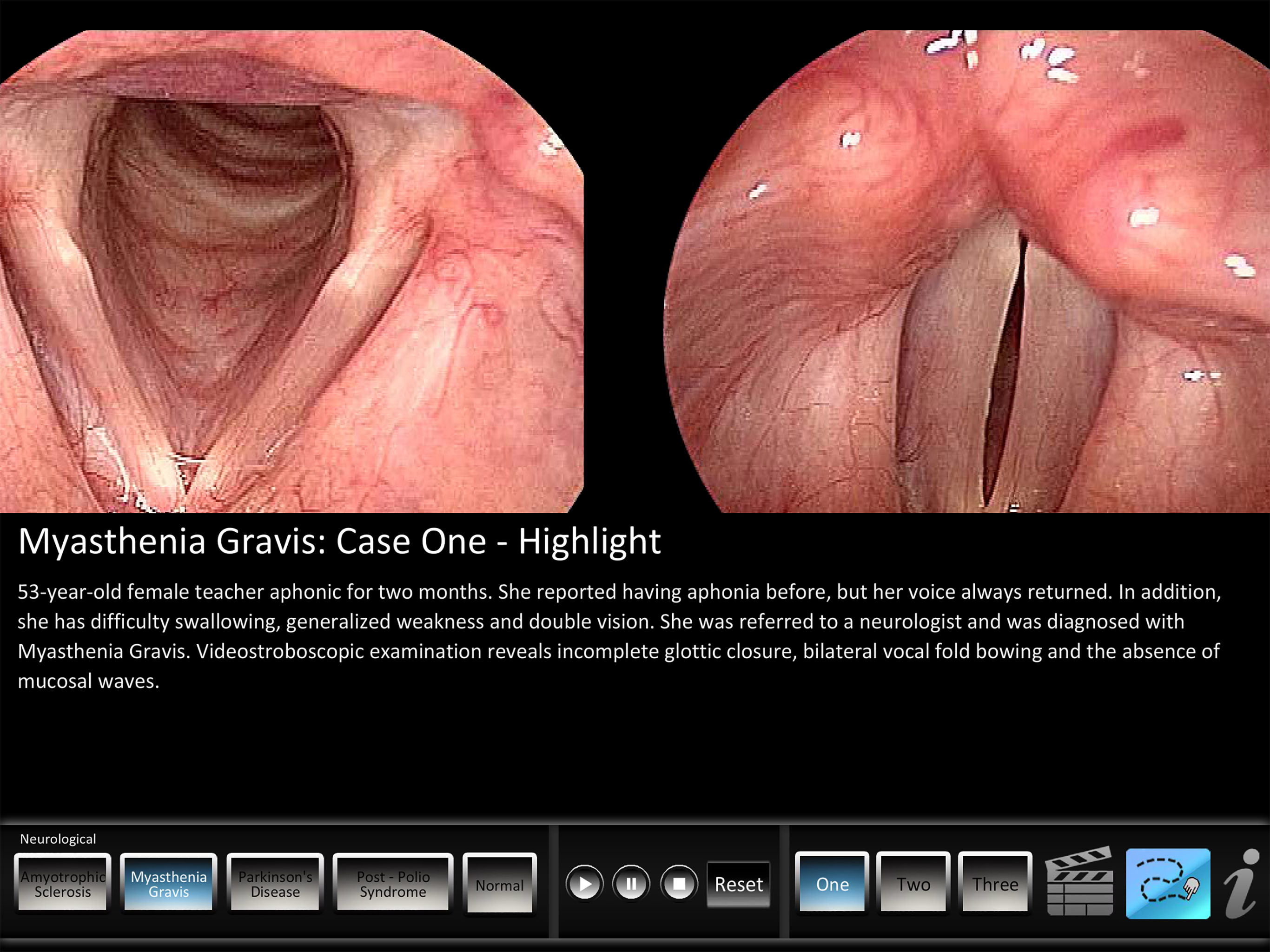 Vocal Pathology: Neurological screenshot 6