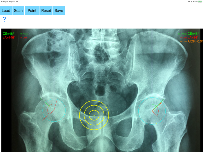 FemoroAcetabularImpingementApp