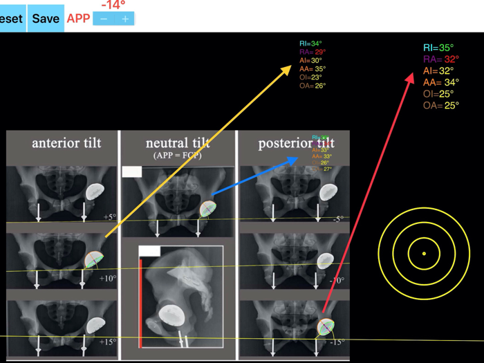 CupAnteversionInclinationApp