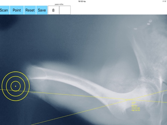 Screenshot #5 pour FemoralAnteversionApp