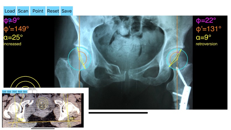 AcetabularAnteversionApp screenshot-0