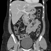 CT Abdomen Pelvis - Lieu Duong