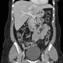 CT Abdomen Pelvis