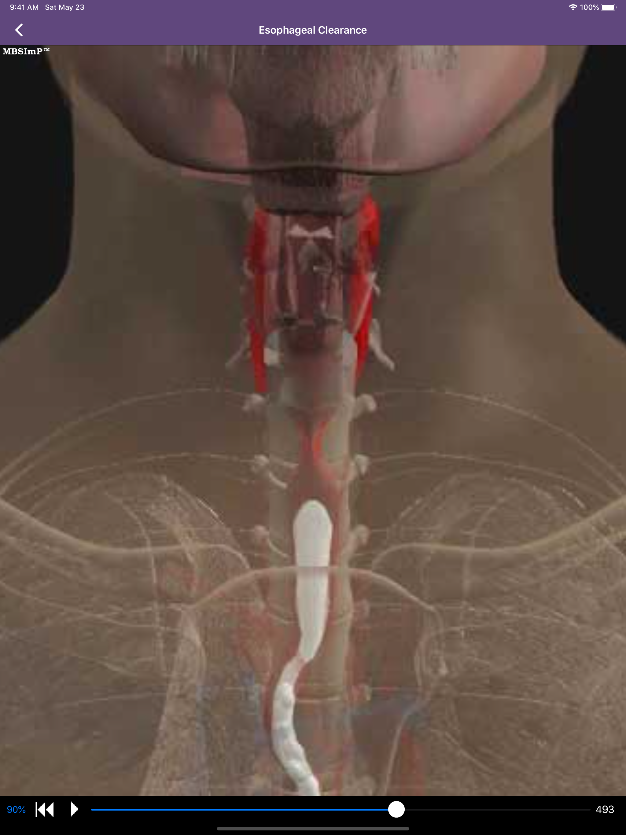 Dysphagia