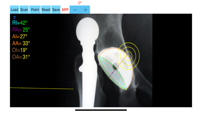 CupAnteversionInclinationApp