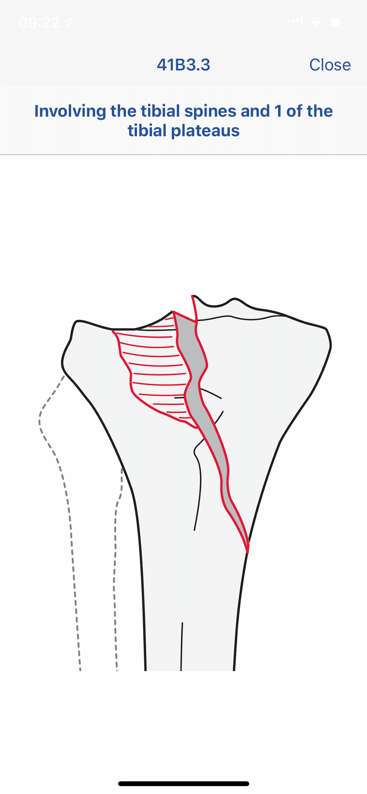 AO/OTA Fracture Classification screenshot 3