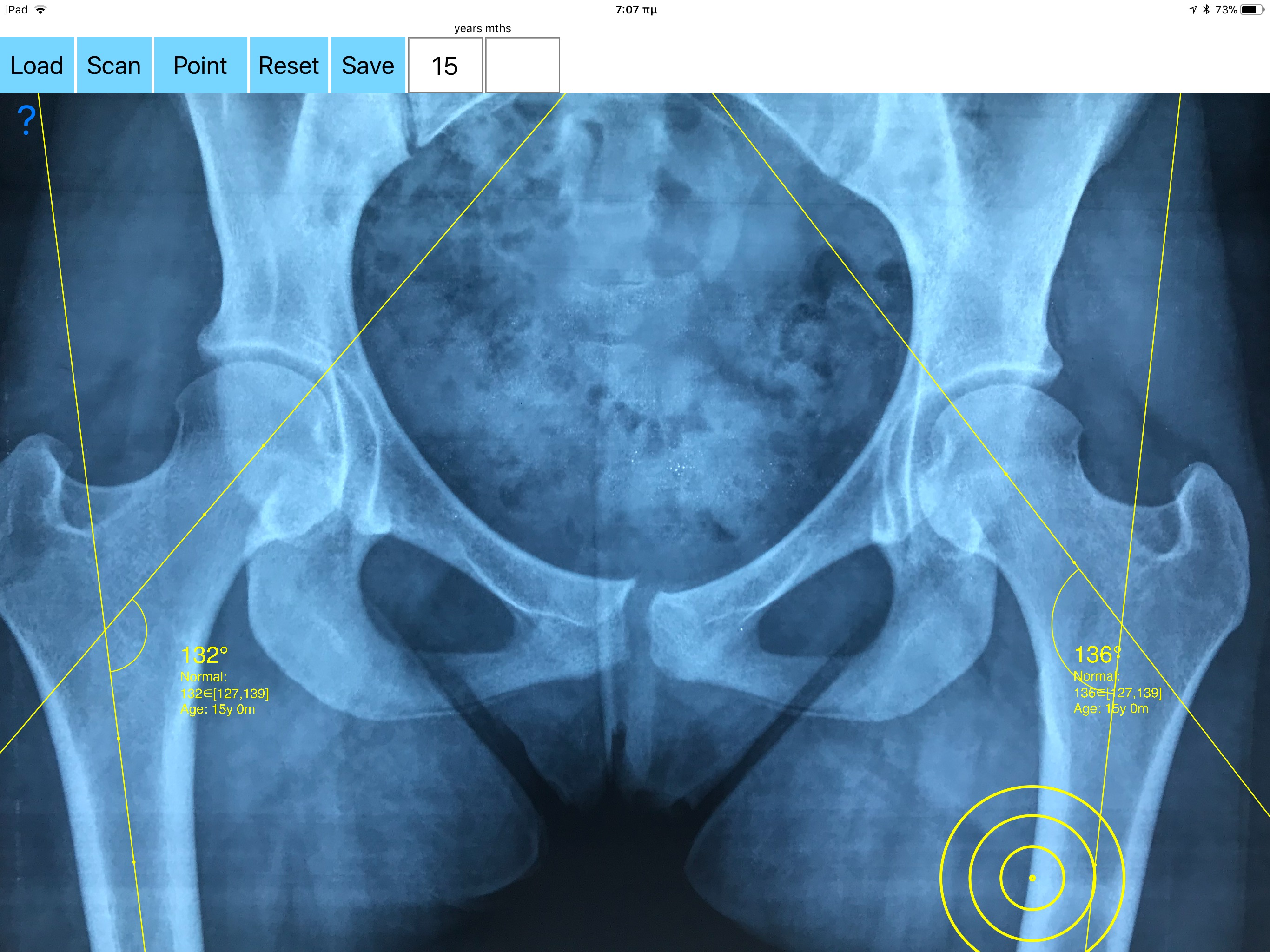 NeckShaftAngle App