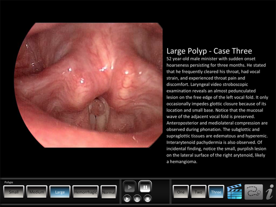Screenshot #5 pour Vocal Pathology: Polyps