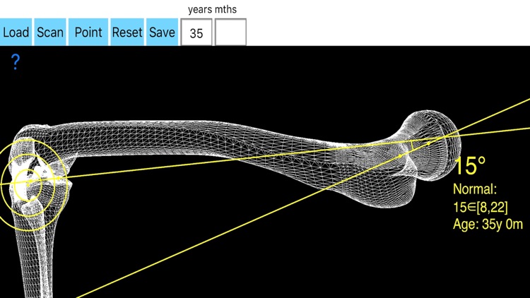FemoralAnteversionApp screenshot-0