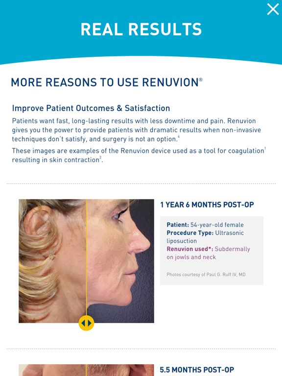 Renuvion iPad screenshot 4 - Medical app