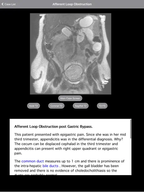 Pregnant Appendicitis