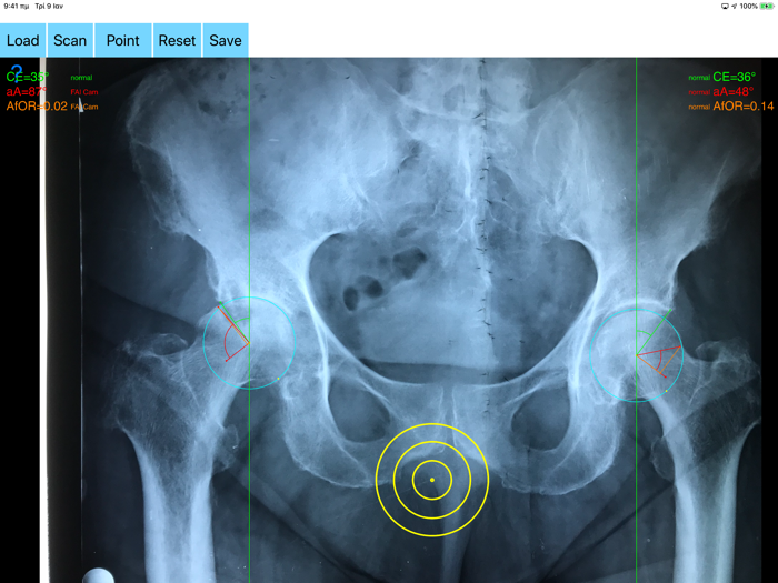 FemoroAcetabularImpingementApp