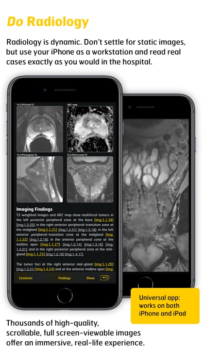 MR Imaging in Prostate Cancer