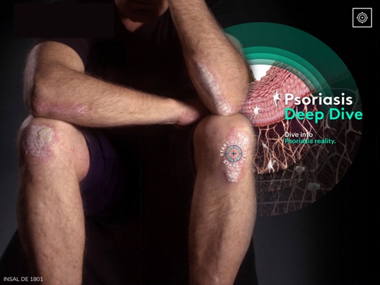 Screenshot #4 pour Psoriasis Deep Dive