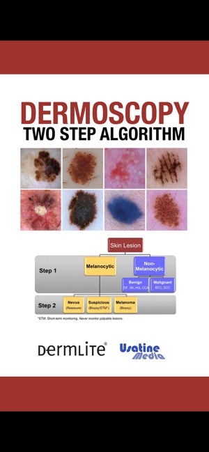 Dermoscopy Two Step Algorithm