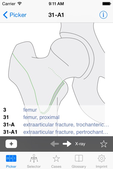 AO/OTA Fracture Classificationのおすすめ画像4