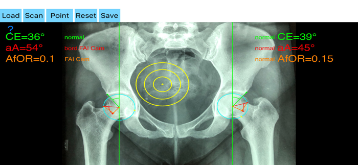 FemoroAcetabularImpingementApp