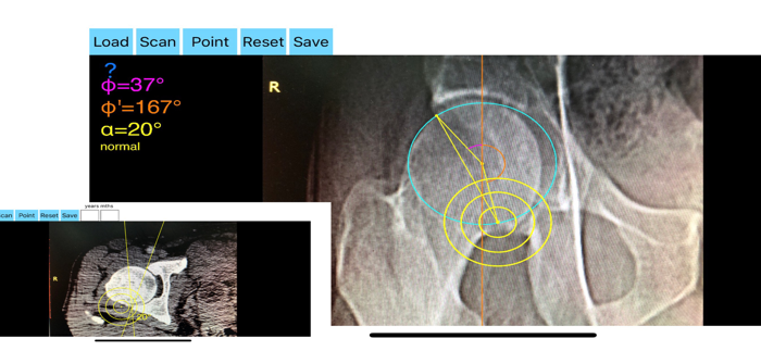 AcetabularAnteversionApp