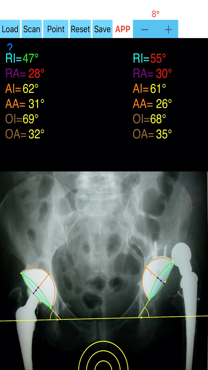 CupAnteversionInclinationApp