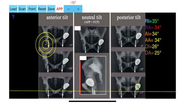 CupAnteversionInclinationApp