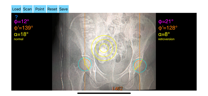 AcetabularAnteversionApp