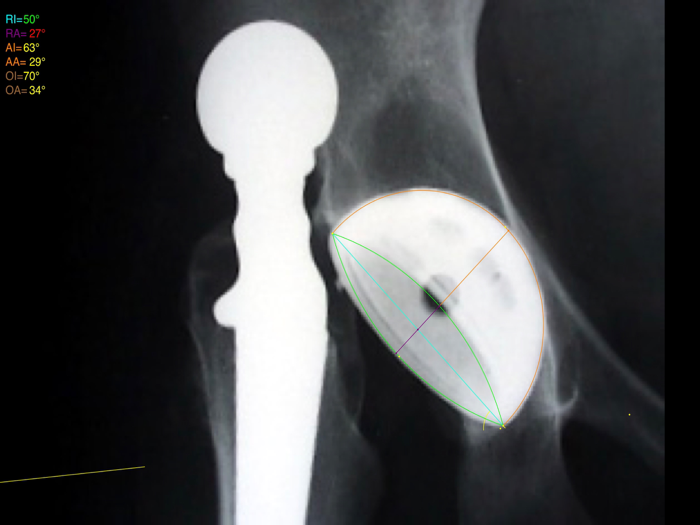 CupAnteversionInclinationApp