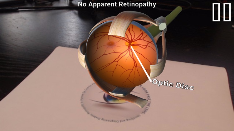 Diabetic Retinopathy AR