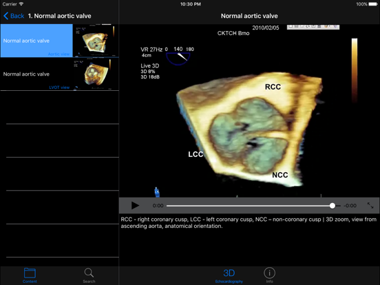 CARDIO3®3D Echocardiography HDのおすすめ画像2