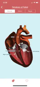 eMurmur Heartpedia screenshot #6 for iPhone