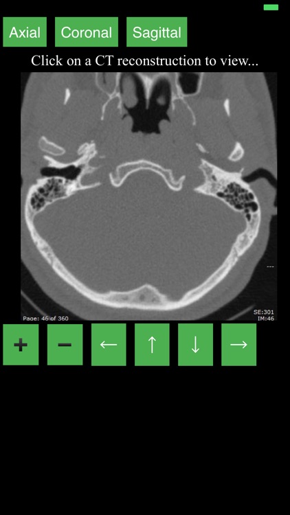 CT Cervical Spine